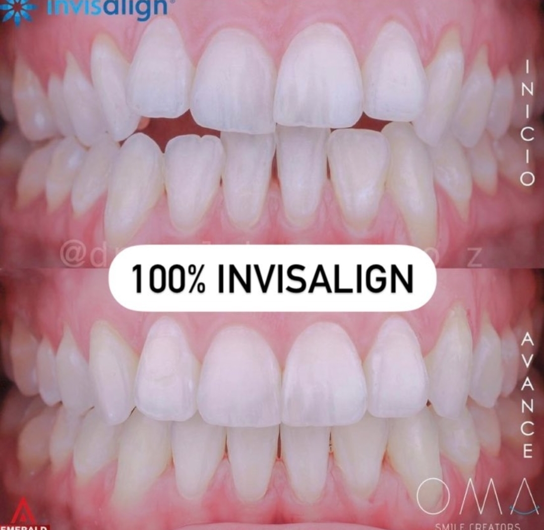 Antes del tratamiento Invisalign
